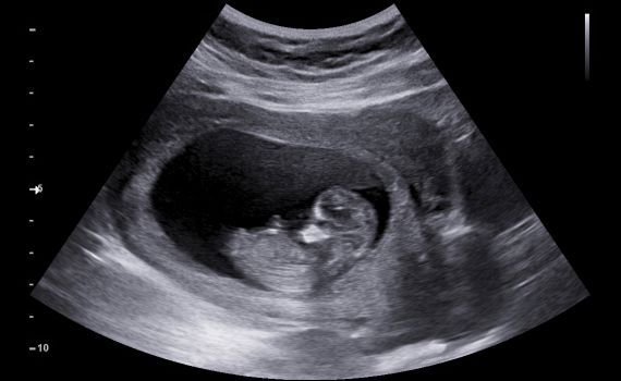 אסותא: "נבקש מביהמ"ש אישור לבדיקות גנטיות"