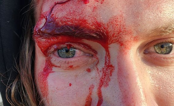 רועה צאן נפגע בראשו מהתקפת אבנים של ערבים