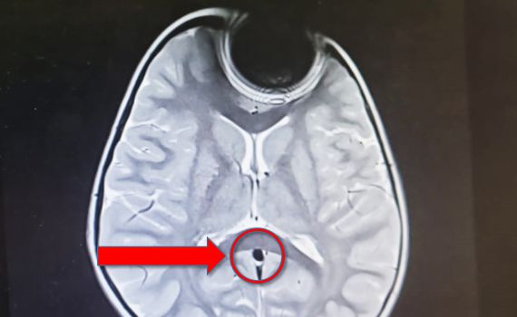 פעוטה פונתה לבית החולים לאחר ששאפה סוללה