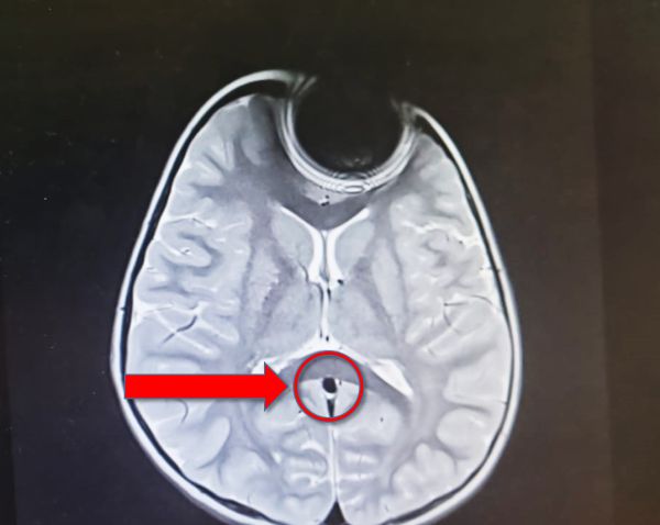 פעוטה פונתה לבית החולים לאחר ששאפה סוללה