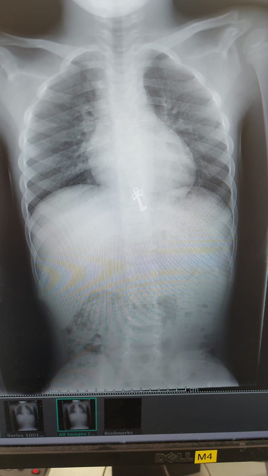 לאחר צילום רנטגן התגלה: בן ה-7 בלע מפתח | תיעוד