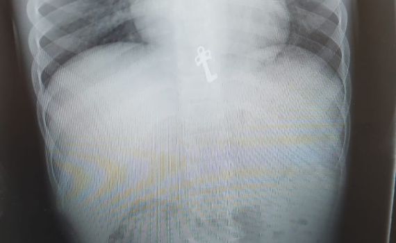 לאחר צילום רנטגן התגלה: בן ה-7 בלע מפתח | תיעוד