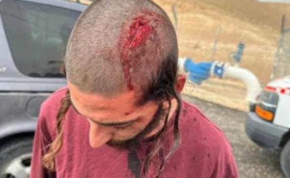 מצפה יריחו: פועלי פינוי אשפה תקפו ופצעו נער