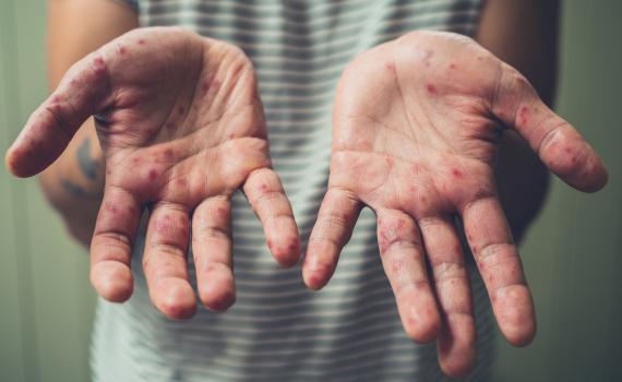 דאגה בישראל: המחלה שהתפשטה בגלל המלחמה עם איראן