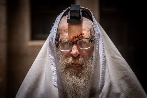 תיעוד: הרב שנחבט במירון עטור בתפילין עם תפרים בראשו