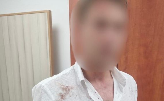 חשד: ערבי תקף את זוגתו לשעבר וגרם לה לחבלות בראש