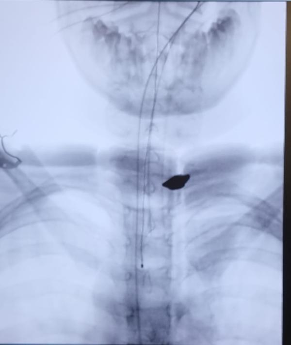 נס: רסיס של 18 מ"מ הוצא מגופו של ילד ממג'דל שמס