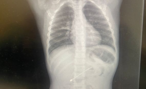 ילד בן 5 מהצפון בלע אנטנה באורך 7.5 ס"מ