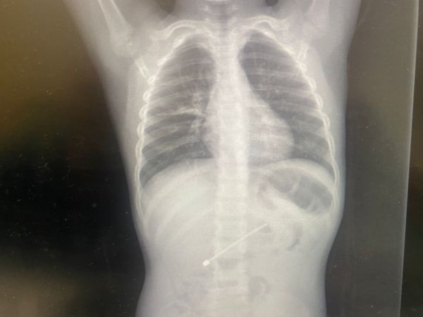 ילד בן 5 מהצפון בלע אנטנה באורך 7.5 ס"מ