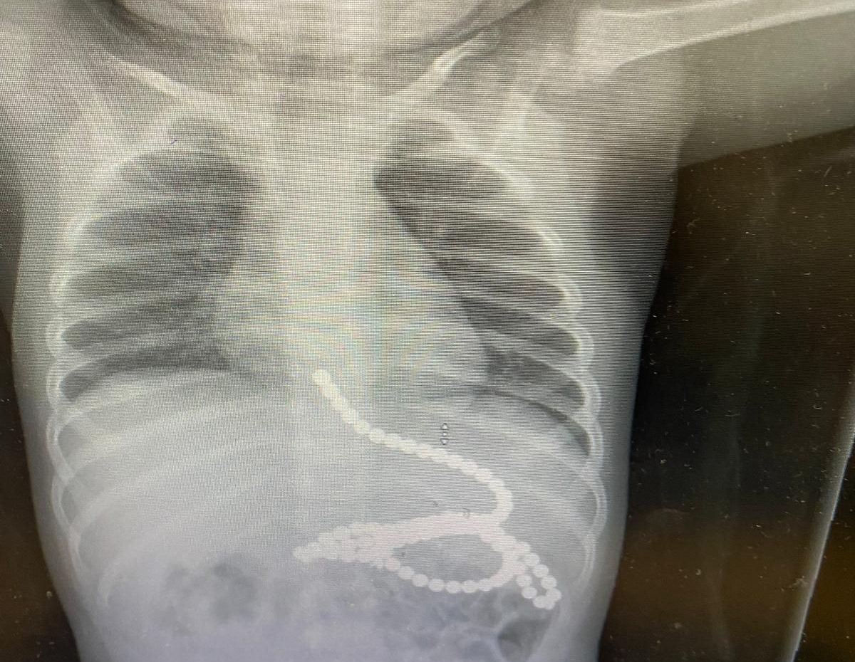 ניצל בנס: פעוט בלע 50 מגנטים, הרופאים הצילו את חייו