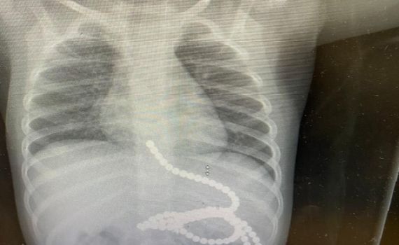 ניצל בנס: פעוט בלע 50 מגנטים, הרופאים הצילו את חייו