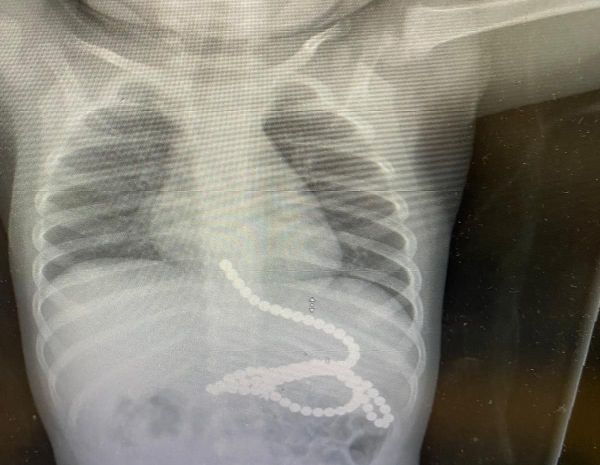 ניצל בנס: פעוט בלע 50 מגנטים, הרופאים הצילו את חייו