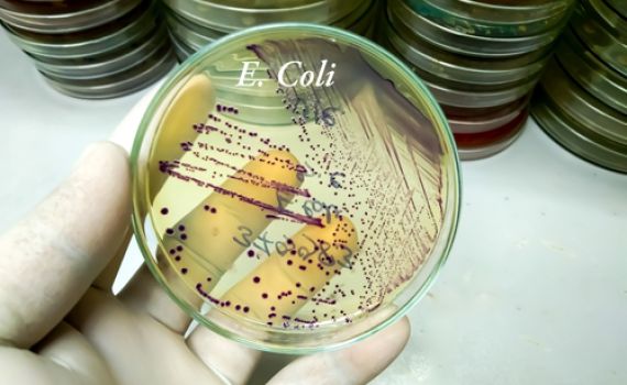 זיהום מסכן חיים מתפשט בישראל. אלו התסמינים