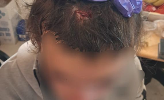 בחסות פעילי שמאל: 2 נערים יהודים הותקפו ע"י פלסטינים בסוסיא