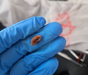 כמעט אסון: פעוט נחנק כי אכל אגוז לכבוד ט"ו בשבט - וניצל