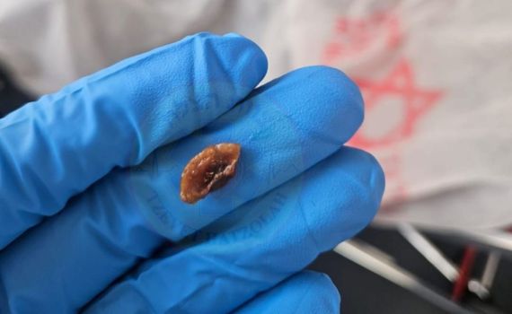 כמעט אסון: פעוט נחנק כי אכל אגוז לכבוד ט"ו בשבט – וניצל