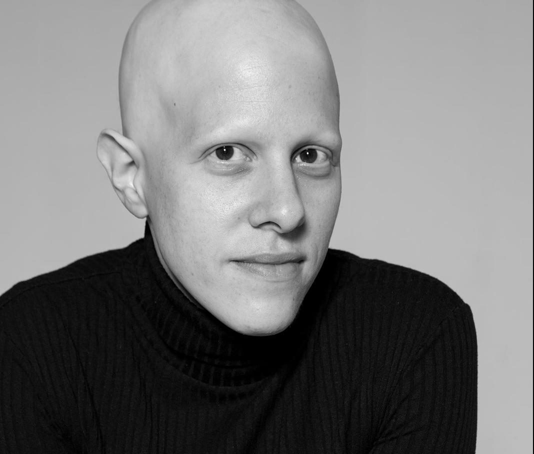 יום הקרחת הבינלאומי: רחלי בדנר חדד בטור אישי